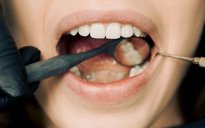 Need a Filling? Here’s Why Tooth-Colored is the Way to Go